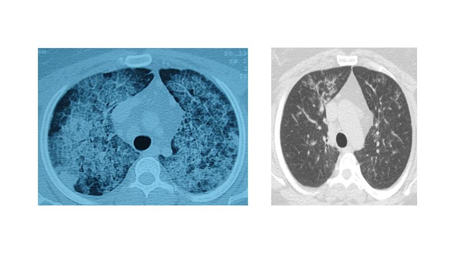 Akciğerlerde yağ birikmesine akciğer yıkama ile çözüm
