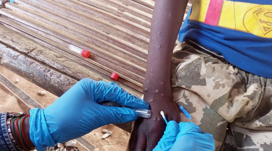 Gana’da ‘maymun çiçeği’ alarmı… Vaka sayısı 583’e yükseldi