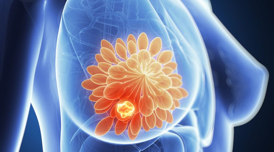 Metastatik Meme Kanseri Tedavisinde Yeni Gelişmeler Metastatik Meme Kanseri Tedavisinde Yeni Gelişmeler